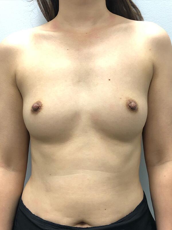 Breast Augmentation Before & After Image