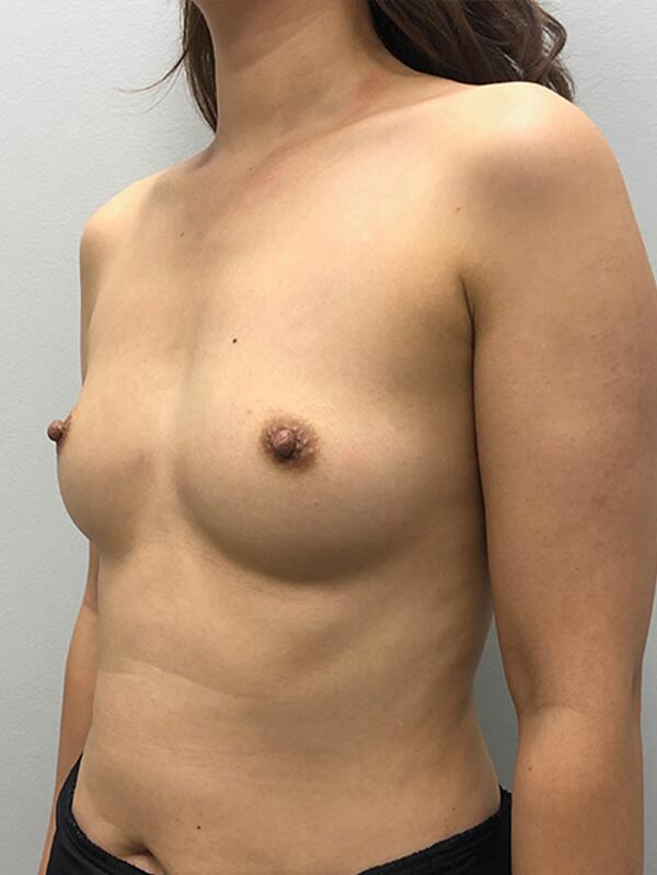 Breast Augmentation Before & After Image