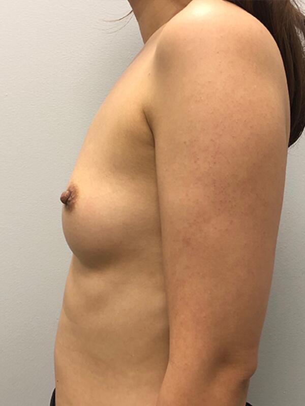 Breast Augmentation Before & After Image