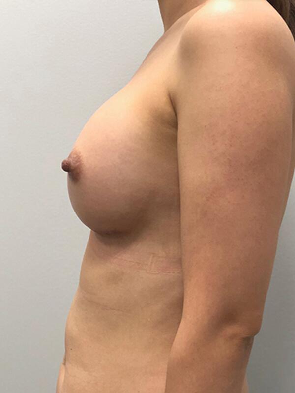 Breast Augmentation Before & After Image