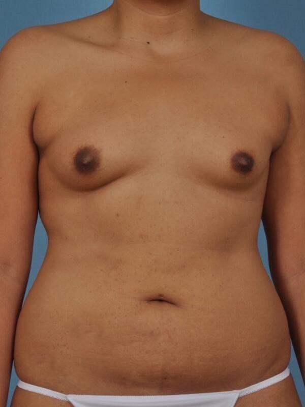 Breast Augmentation Before & After Image