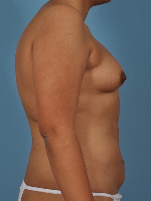 Breast Augmentation Before & After Image