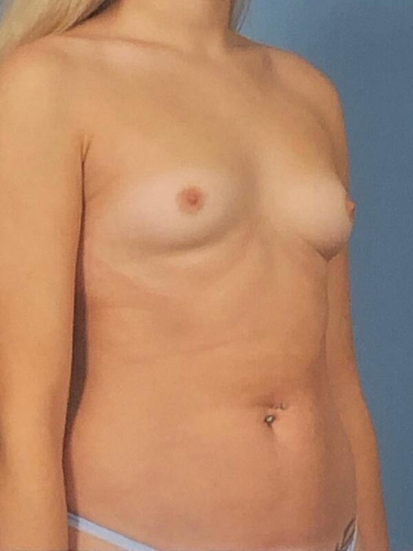 Breast Augmentation Before & After Image