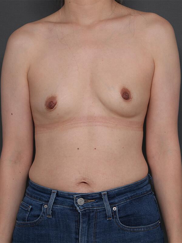 Breast Augmentation Before & After Image