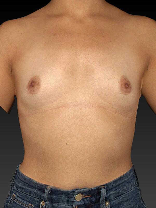 Breast Augmentation Before & After Image