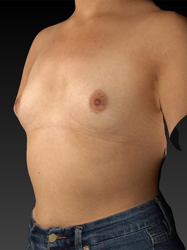 Breast Augmentation Before & After Image