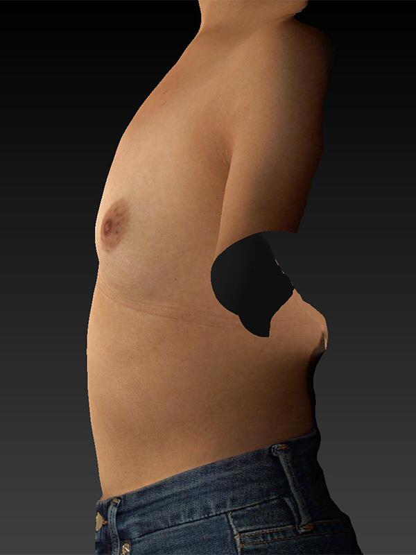 Breast Augmentation Before & After Image