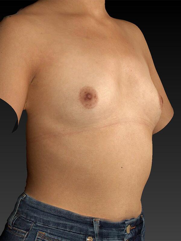 Breast Augmentation Before & After Image