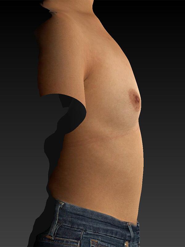 Breast Augmentation Before & After Image