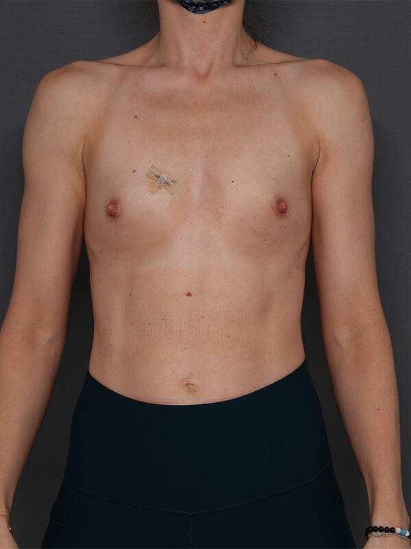 Breast Augmentation Before & After Image