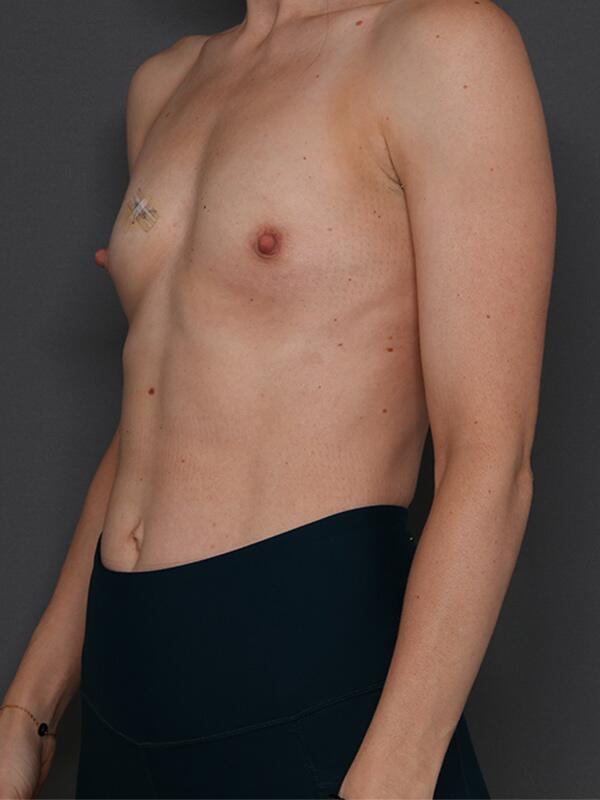 Breast Augmentation Before & After Image