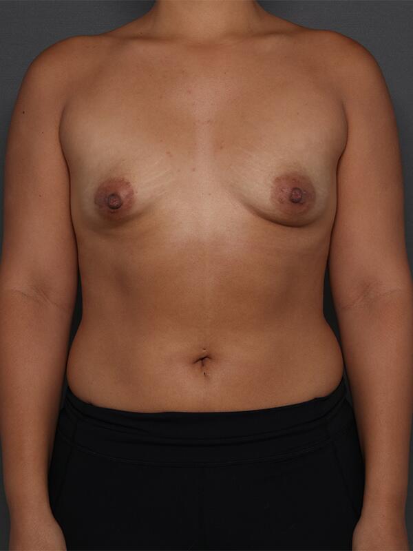 Breast Augmentation Before & After Image