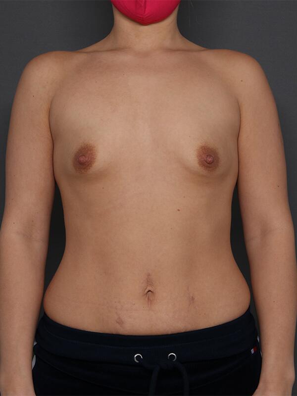 Breast Augmentation Before & After Image