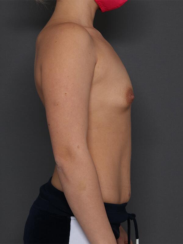 Breast Augmentation Before & After Image