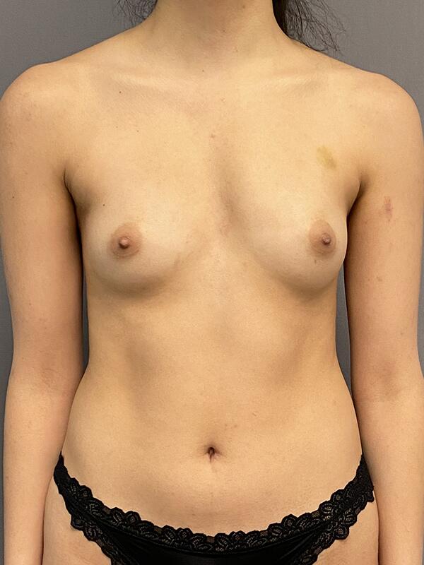 Breast Augmentation Before & After Image