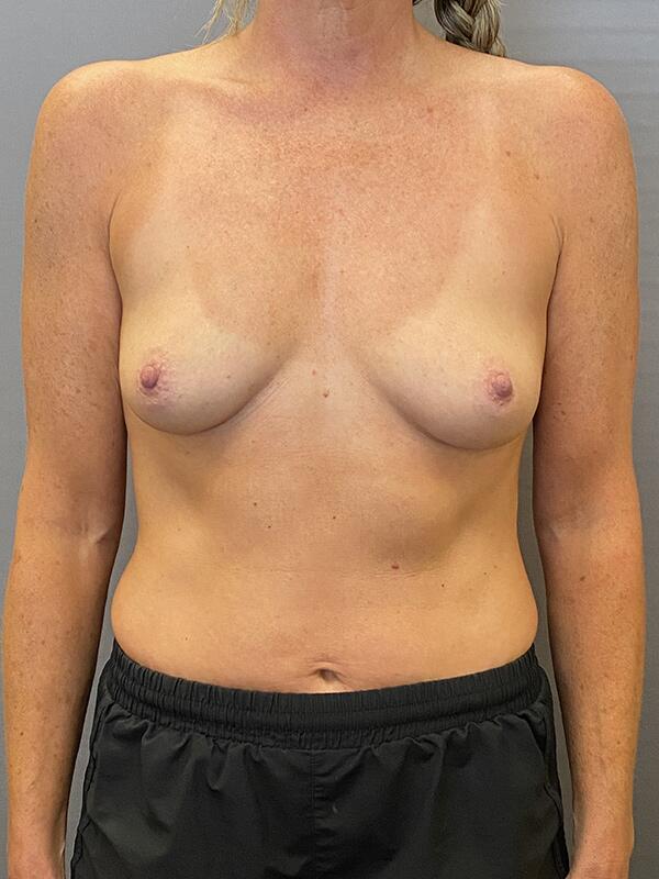 Breast Augmentation Before & After Image