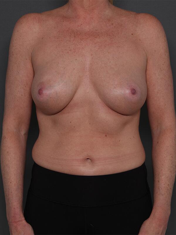 Breast Augmentation Before & After Image