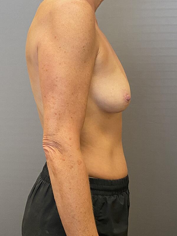 Breast Augmentation Before & After Image