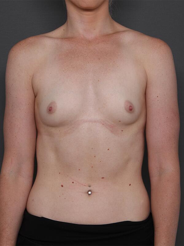 Breast Augmentation Before & After Image