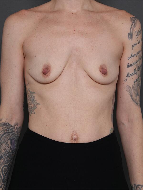 Breast Augmentation Before & After Image