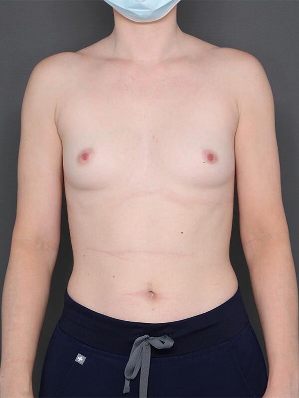 Breast Augmentation Before & After Image