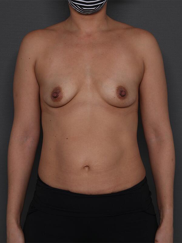 Breast Augmentation Before & After Image