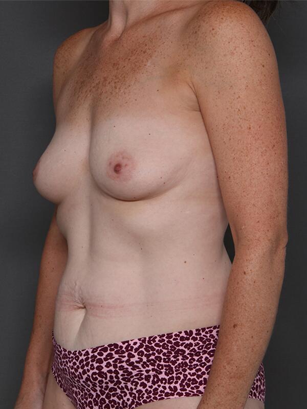 Breast Augmentation Before & After Image