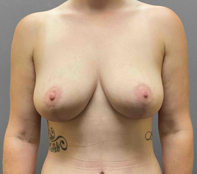 Breast Lift Before & After Image