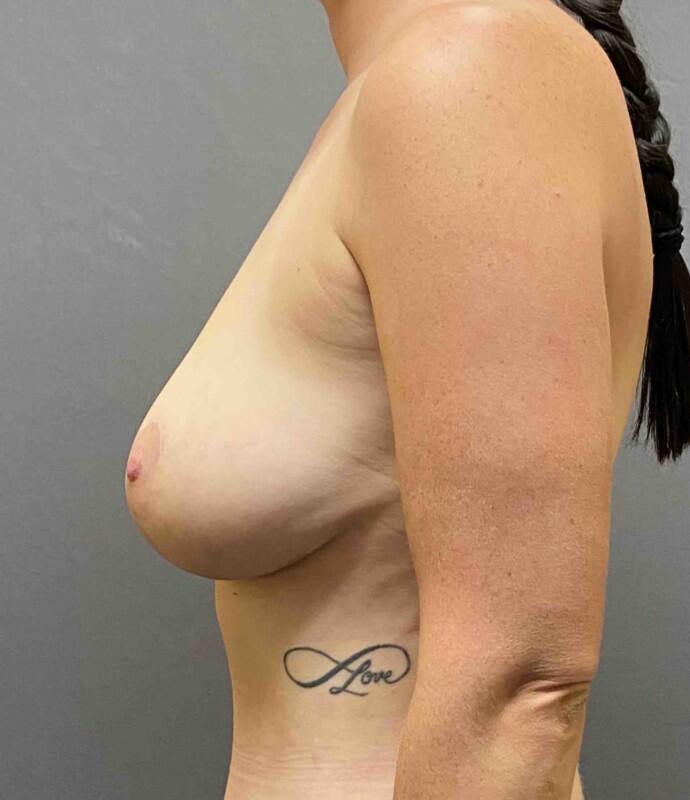 Breast Lift Before & After Image