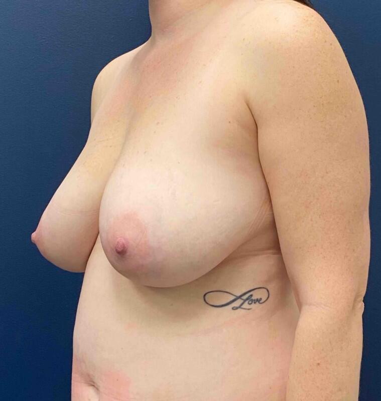 Breast Lift Before & After Image