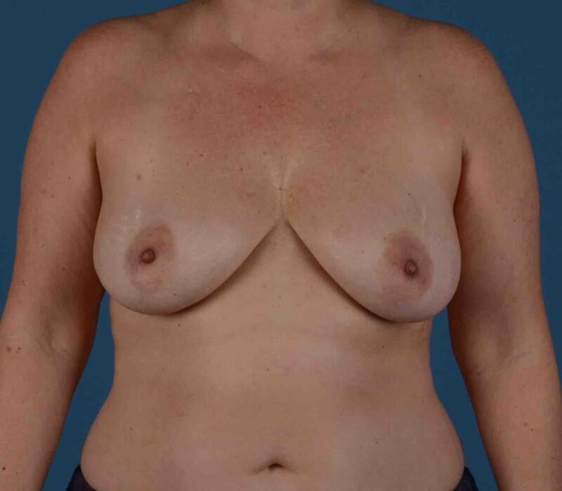 Breast Lift Before & After Image