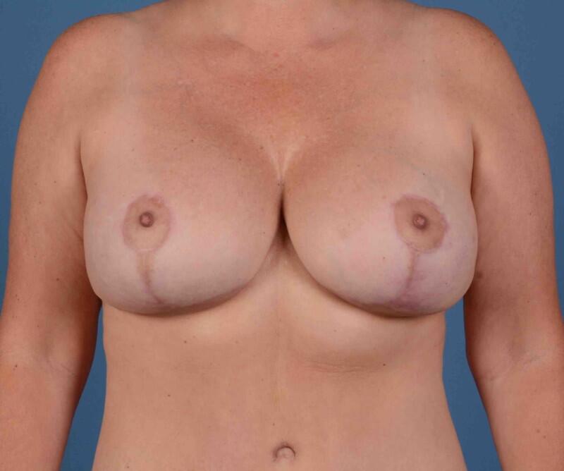 Breast Lift Before & After Image