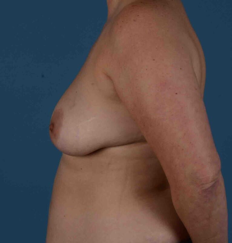 Breast Lift Before & After Image