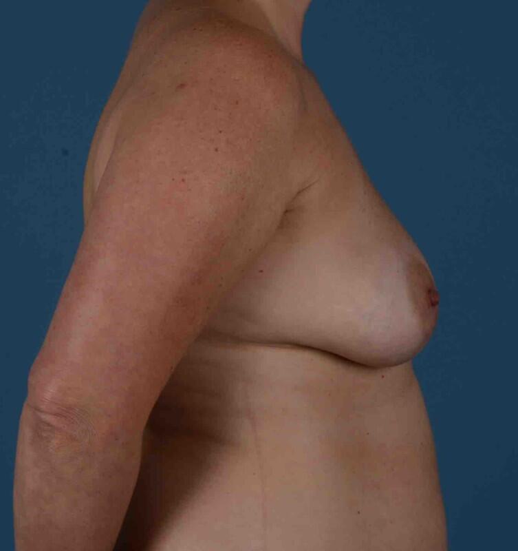 Breast Lift Before & After Image