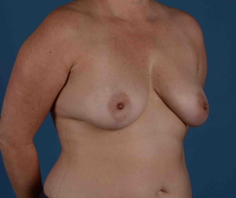 Breast Lift Before & After Image