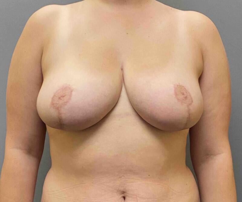 Breast Reduction Before & After Image