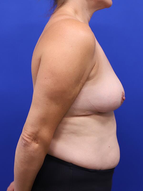 Breast Reduction Before & After Image