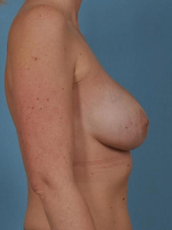 Breast Revision Before & After Image