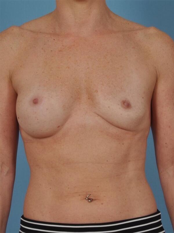 Breast Revision Before & After Image