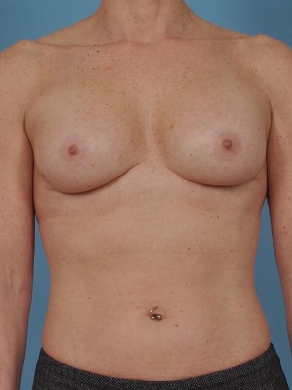 Breast Revision Before & After Image