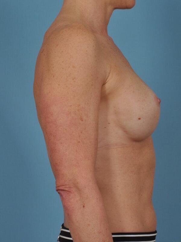 Breast Revision Before & After Image