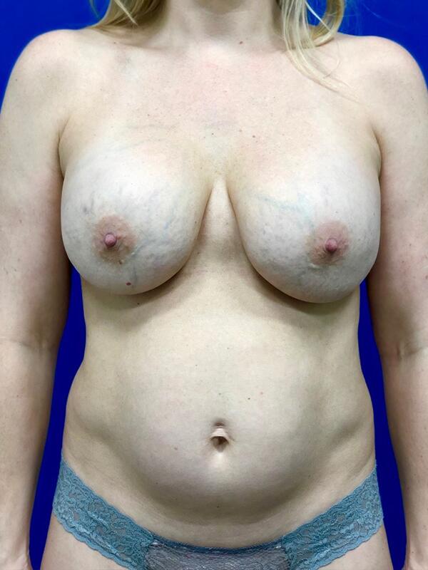 Breast Revision Before & After Image