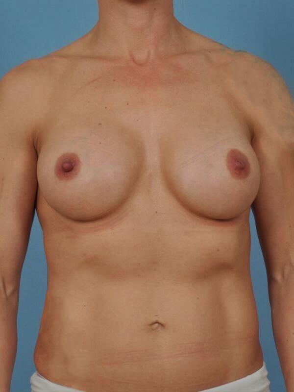 Breast Revision Before & After Image