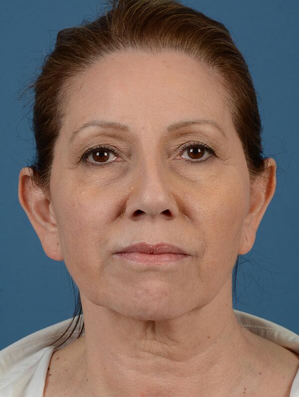 Facelift Before & After Image