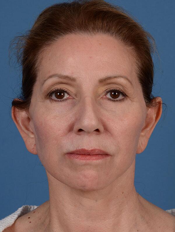 Facelift Before & After Image