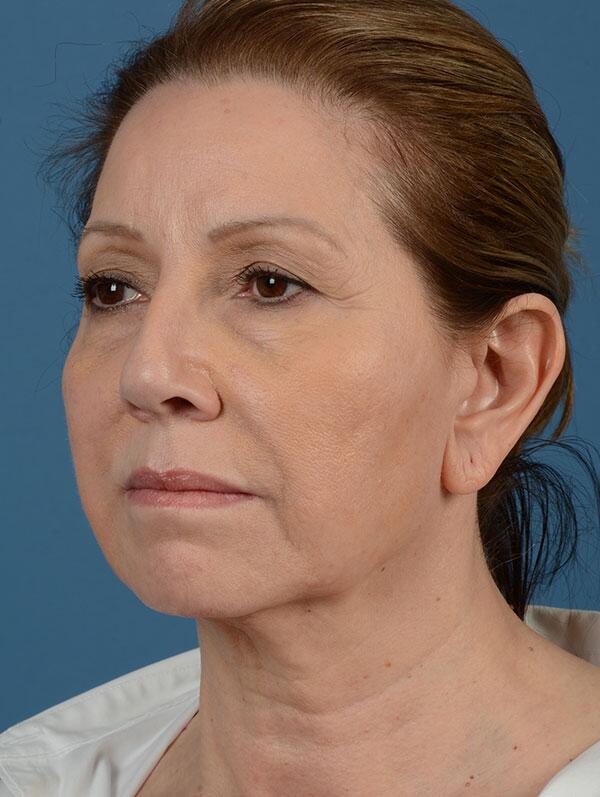 Facelift Before & After Image