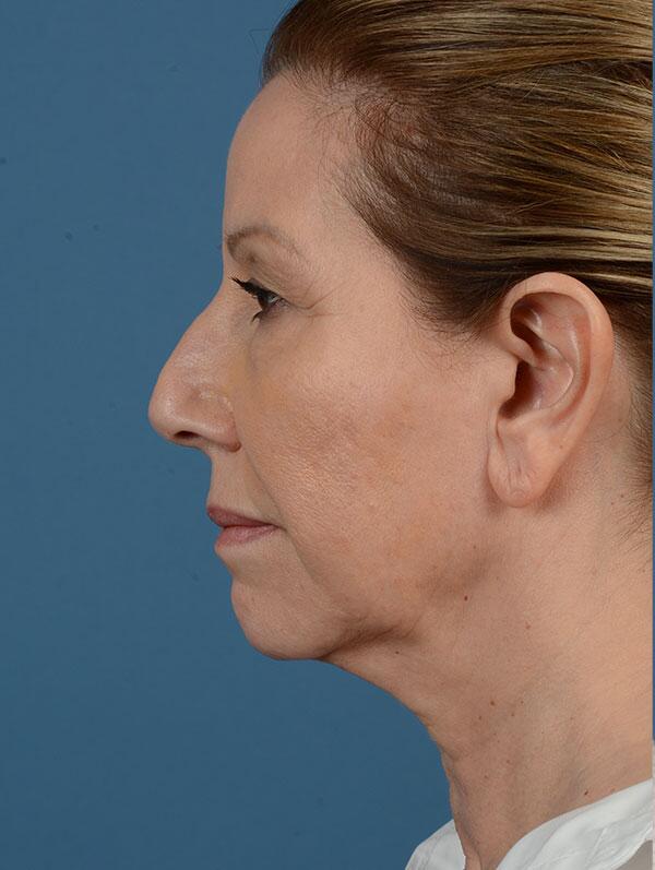 Facelift Before & After Image