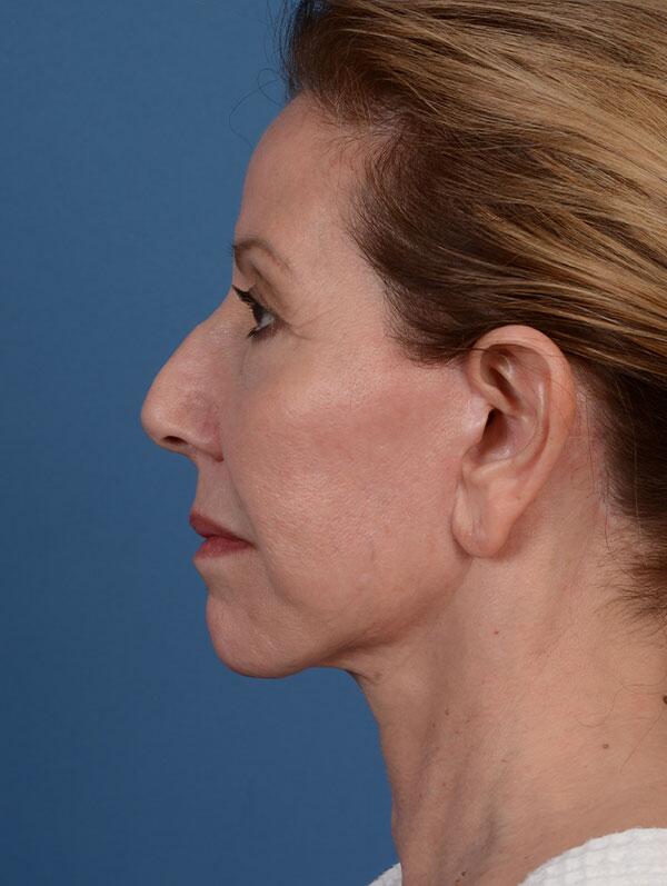 Facelift Before & After Image