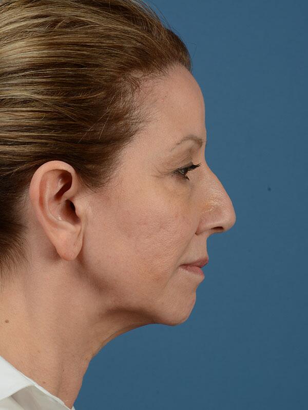 Facelift Before & After Image