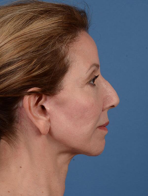 Facelift Before & After Image